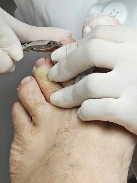 Clínica de unhas encravadas