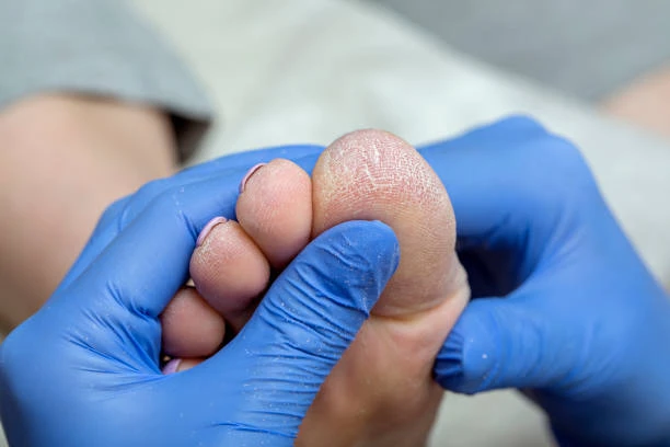 Tratamento para rachadura nos pés em Belo Horizonte