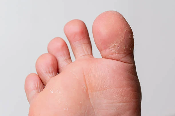 Tratamento para rachadura nos pés em Betim