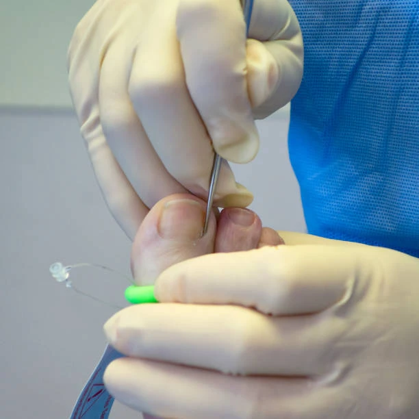 Tratamento de unha encravada inflamada