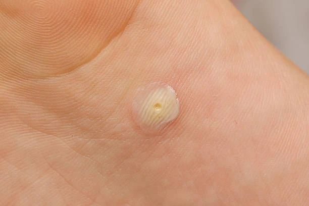 Tratamento contra verruga no pé