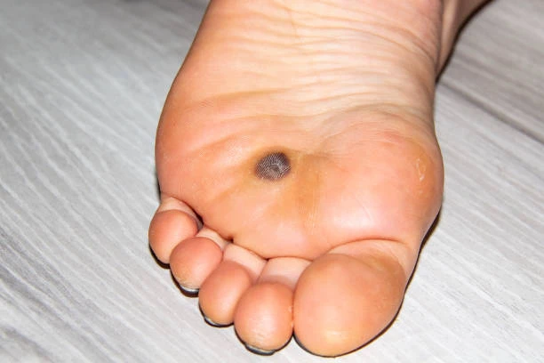 Tratamento de verruga plantar na podologia em Betim