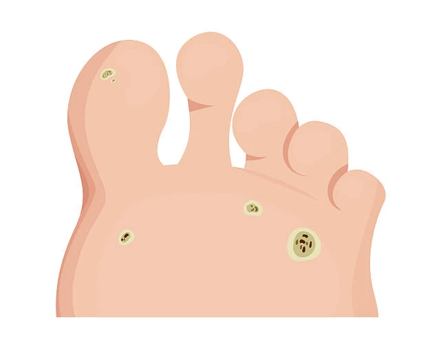 Verruga na planta do pé tratamento em Belo Horizonte