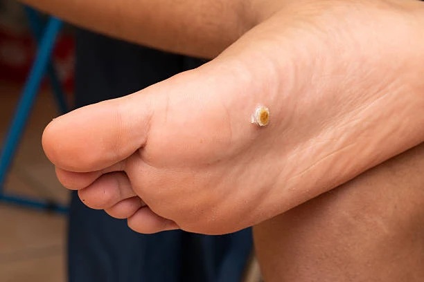 Verruga na planta do pé tratamento em Betim